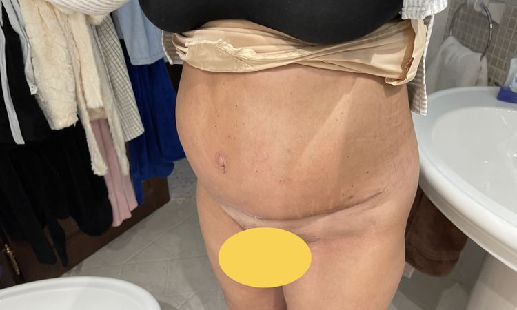 Otok břicha i 6 týdnů po lipoabdominoplastice s nápravou diastázy - 46409