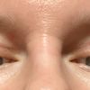 Převisy kůže po operaci očních víček - 46699