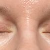 Převisy kůže po operaci očních víček - 46700