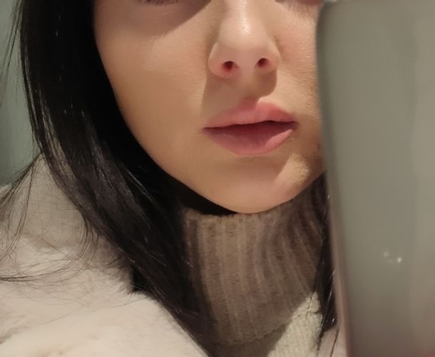 Bichektomie, lipolýza, výplně KH nebo radiofrekvence?