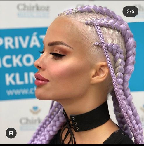 Bichektomie, lipolýza, výplně KH nebo radiofrekvence?