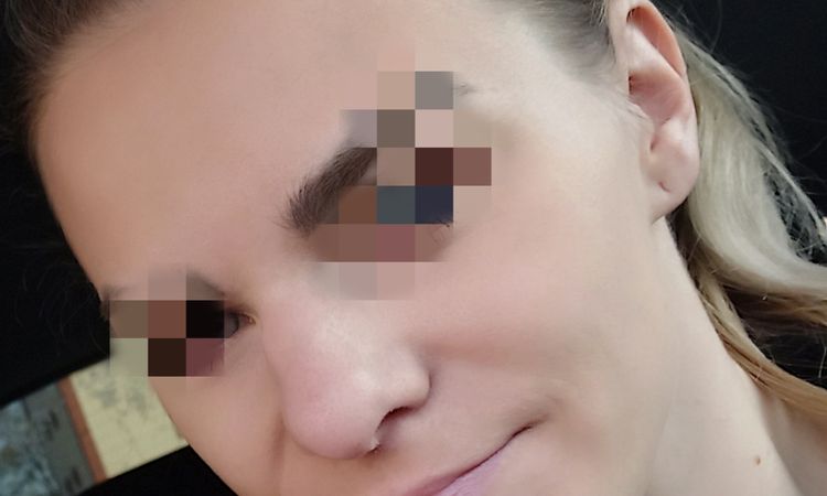 Sekundární rhinoplastika - 48627