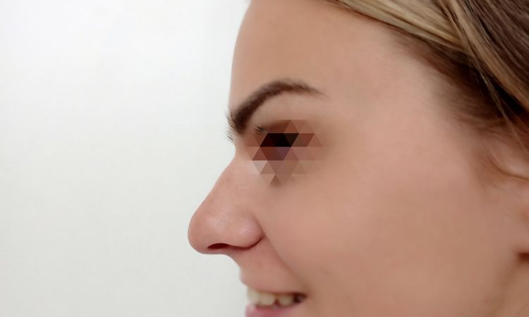 Sekundární rhinoplastika - 48628