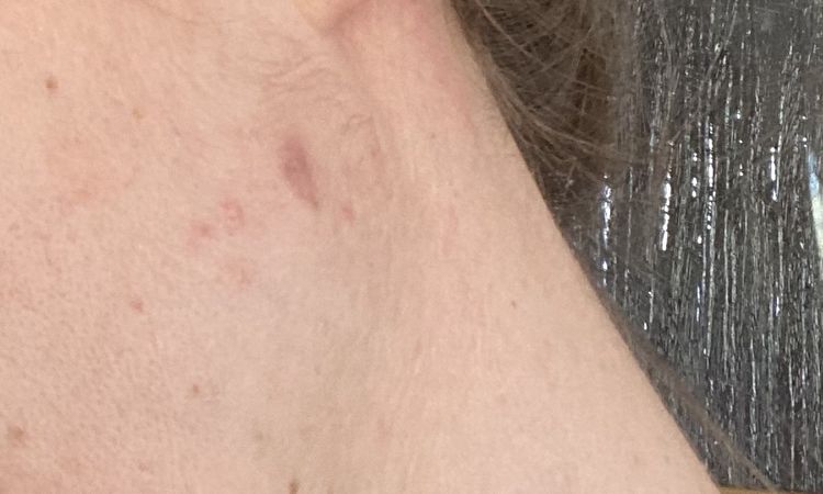 Granuloma faciale - jak odstranit? - 49713