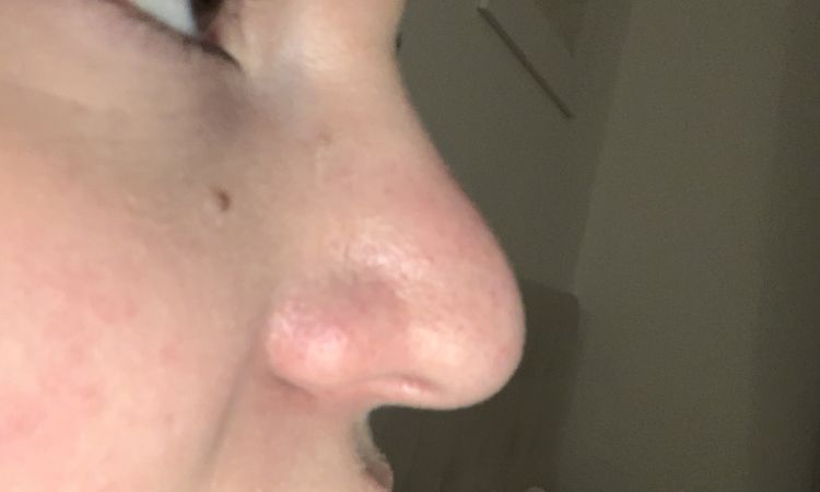 Rhinoplastika měkké části potřetí kvůli jizvám? - 50403