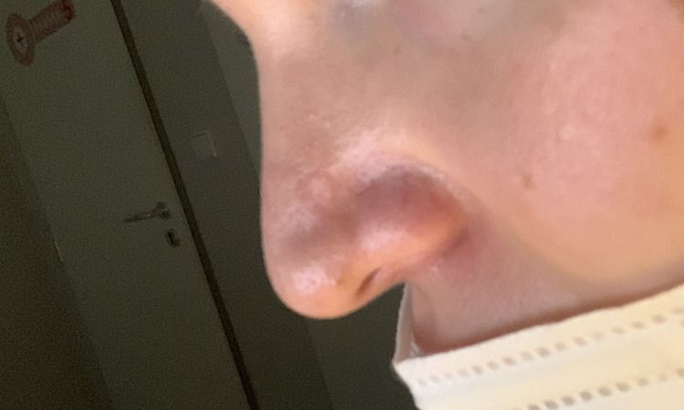 Rhinoplastika měkké části potřetí kvůli jizvám? - 50404