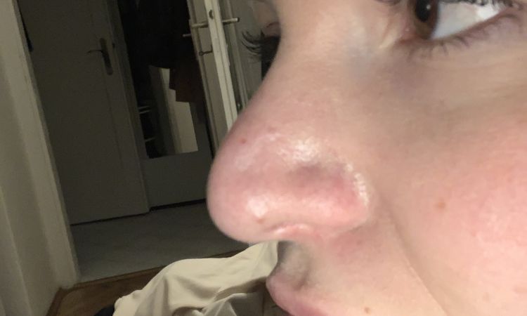 Rhinoplastika měkké části potřetí kvůli jizvám? - 50406