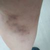 Fialová žilní pigmentace na noze