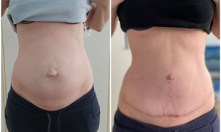 Vyklenute bricho po abdominoplastice - 51347