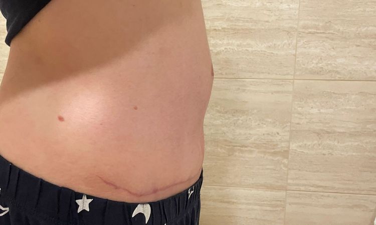 Vyklenute bricho po abdominoplastice - 51349