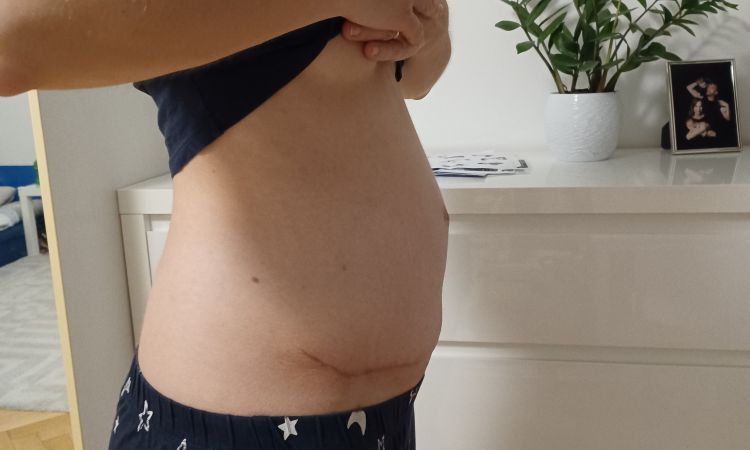 Vyklenute bricho po abdominoplastice - 51350