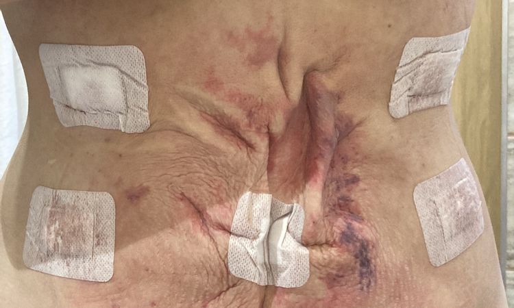 Liposukce slim lipo břicha - nespokojenost s výsledkem - 53044