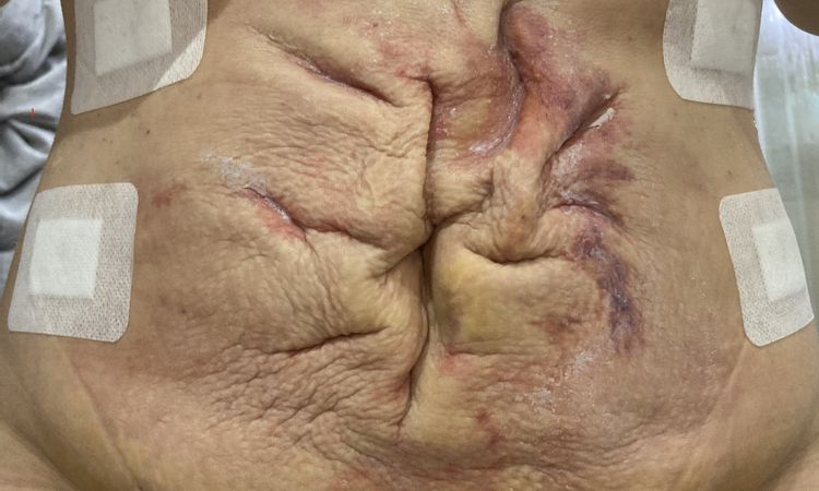 Liposukce slim lipo břicha - nespokojenost s výsledkem - 53045
