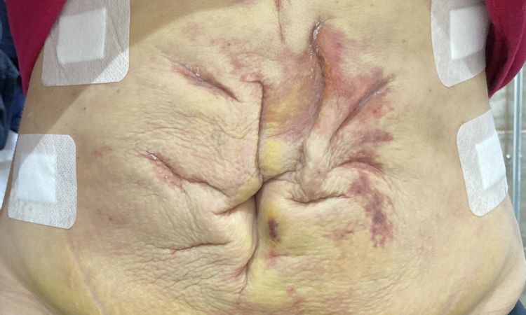 Liposukce slim lipo břicha - nespokojenost s výsledkem - 53046