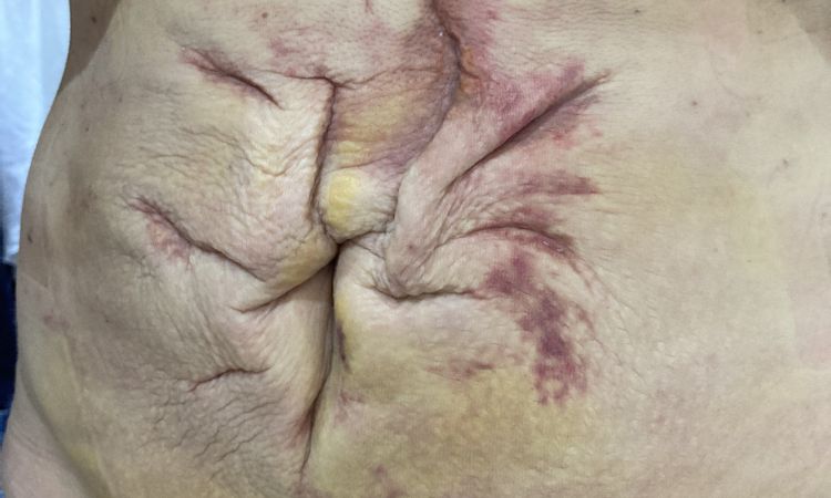 Liposukce slim lipo břicha - nespokojenost s výsledkem - 53047