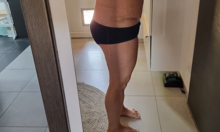 Otoky po abdominoplastice + finální vzhled - 53277