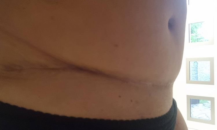 Vtažení jizvy po abdominoplastice - 53856