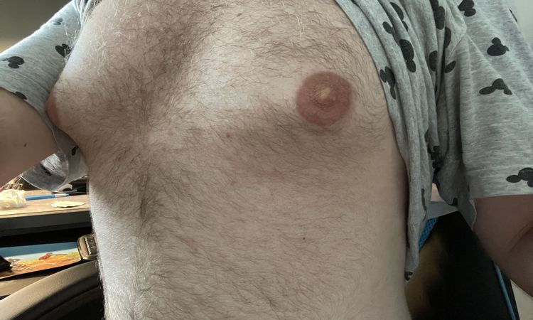 Jedná se o gynekomastii? - 54605