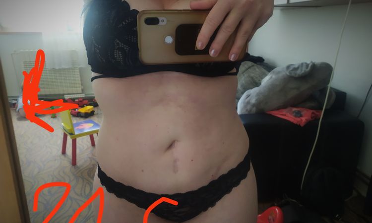 Liposukce bricha a boku - 54766