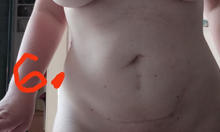 Liposukce bricha a boku - 54767