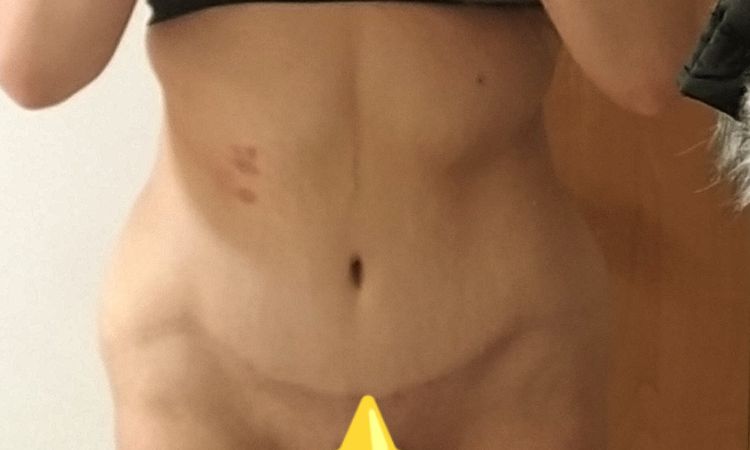 Liposukce a stažení kůže - 55412