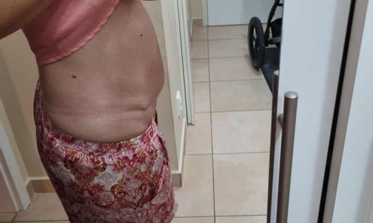 Ostrá bolest a rozestup po abdominoplastice - 55526