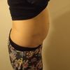 Neprovedená liposukce?