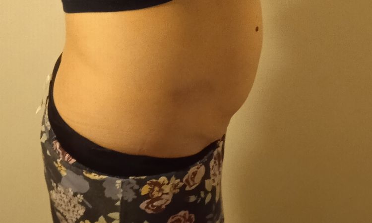 Neprovedená liposukce? - 56241