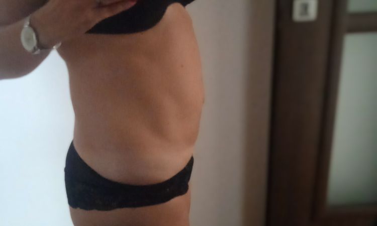 Neprovedená liposukce? - 56243