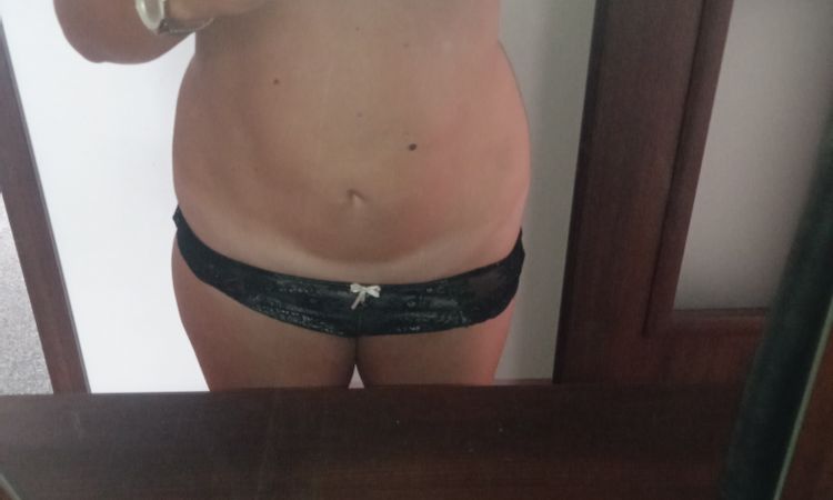 Neprovedená liposukce? - 56247