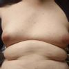 Mám gynekomastie?? Je možná operace na pojišťovnu?