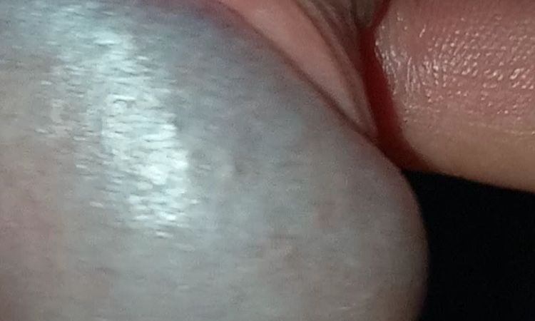 Žalud, kůže, kondolymata? - 56703