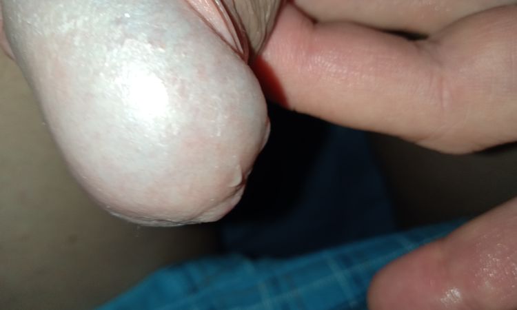 Žalud, kůže, kondolymata? - 56708