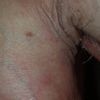 Hyperpigmentace penis