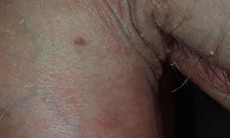 Hyperpigmentace penis - 57281