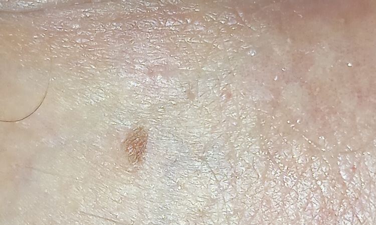 Hyperpigmentace penis - 57282