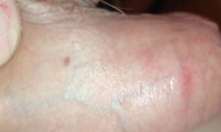 Hyperpigmentace penis - 57283