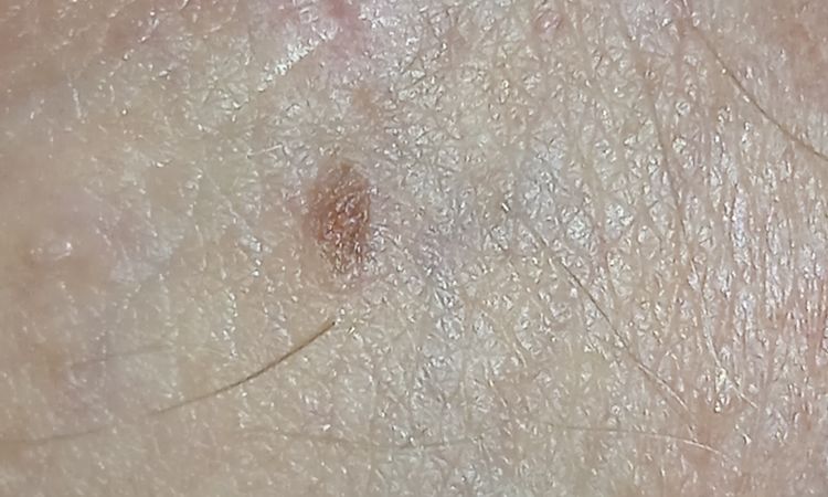 Hyperpigmentace penis - 57284