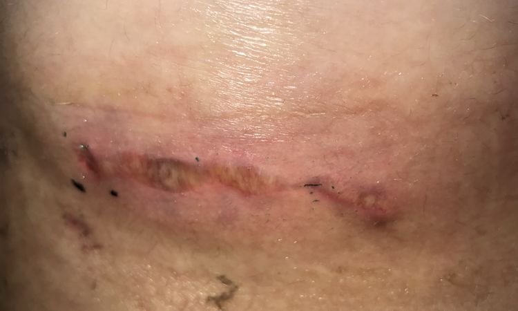 Tělo nechce přijmout implantát - 57472
