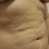 Oprava po liposukci SlimLipo