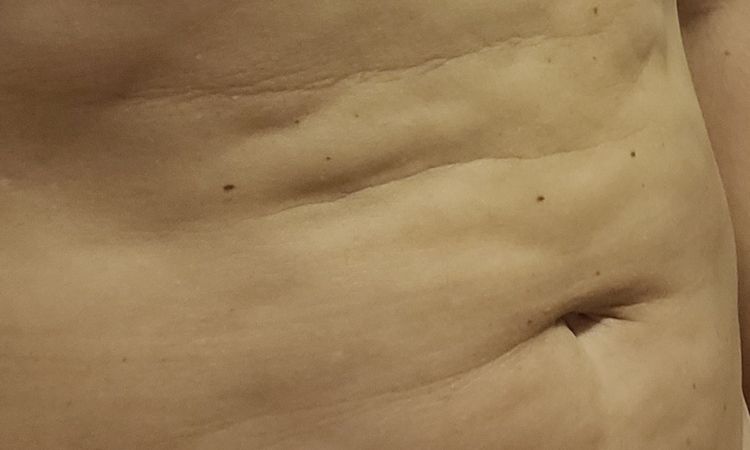 Oprava po liposukci SlimLipo - 57627