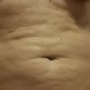 Oprava po liposukci SlimLipo
