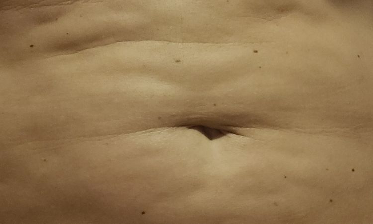 Oprava po liposukci SlimLipo - 57628