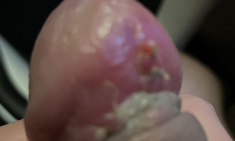 Rekonvalescence po obřízce - 57809