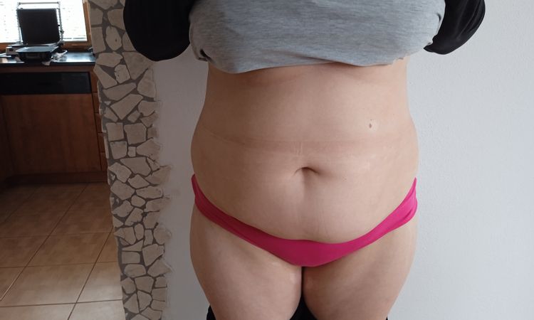 Liposukce břicha a boků - 58042