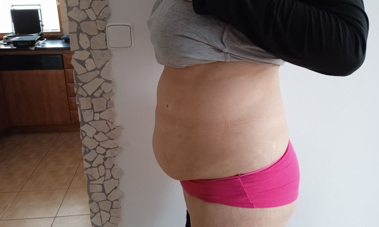 Liposukce břicha a boků - 58043
