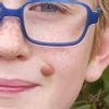 Odstranění pihy z obličeje u dítěte