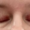 IPL očních víček - oční rosacea