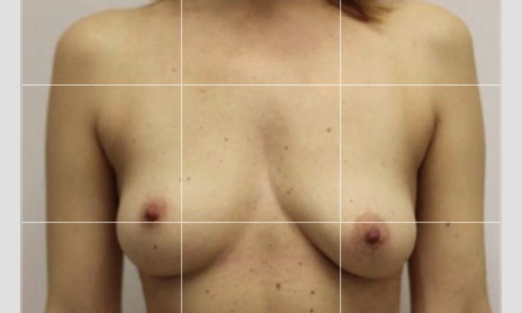 Přetrvávající asymetrie po augmentaci - 58544
