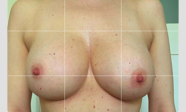 Přetrvávající asymetrie po augmentaci - 58545